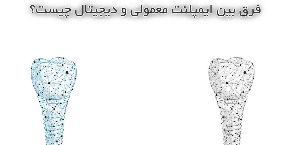 فرق بین ایمپلنت معمولی و دیجیتال