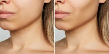 آیا عمل بوکال فت با عوارض همراه است؟