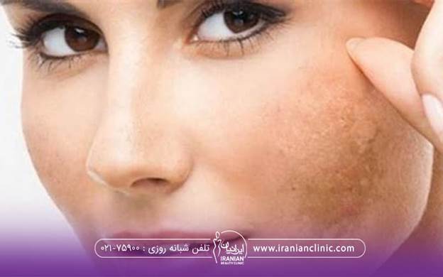 روزی صورت فرد عوارض بلند مدت استفاده از لیزر فوتونا است