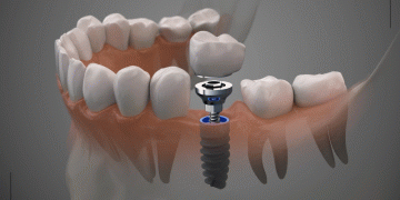 ایمپلنت دندان یک روزه چگونه انجام می شود؟