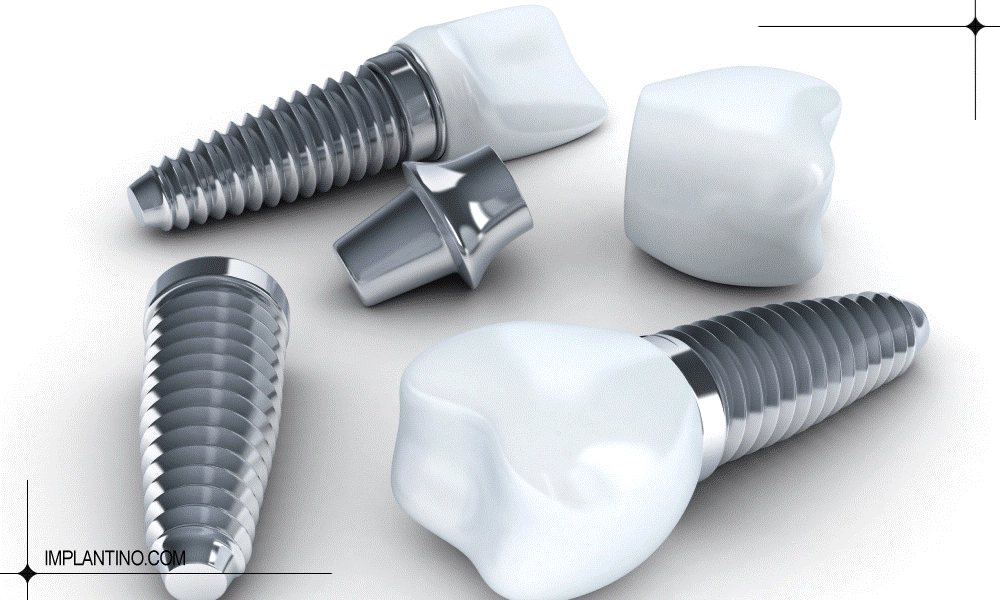 Several dental implants AI-generated content may be incorrect.