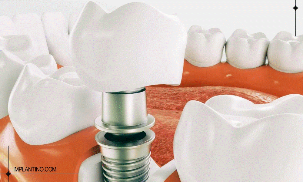 A close-up of a dental implant AI-generated content may be incorrect.