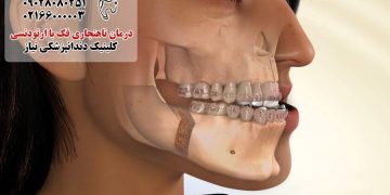 درمان ناهنجاری فک با ارتودنسی
