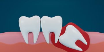 هزینه کشیدن دندان عقل در سال ۱۴۰۴